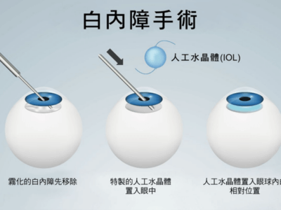 Cataract eye surgery