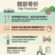 Hip Fracture